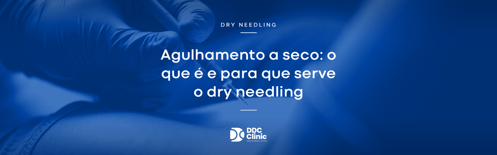 Agulhamento a seco (dry needling): o que é, para que serve e quando é indicado